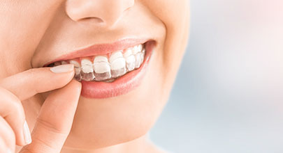 Invisalign | Northgate Dental Centre